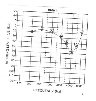 Audiogram Noice induced hearing loss