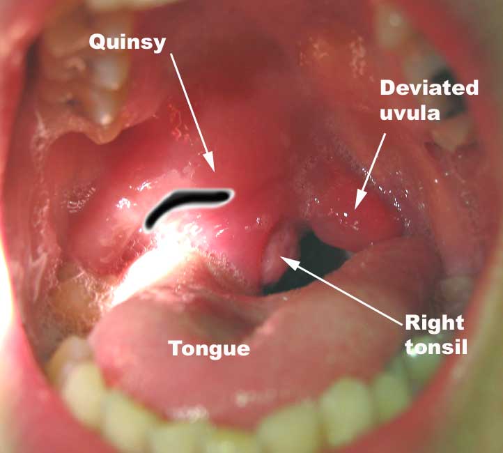 quinsy incision