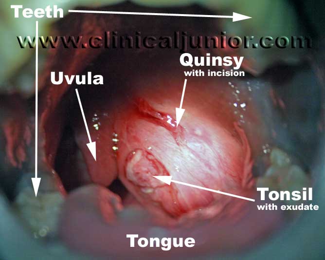 quinsy incision